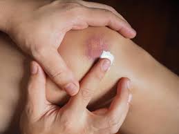 Do this after every hour for the first 24 hours. How To Get Rid Of Bruises 7 Effective Home Remedies