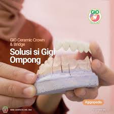 Hampir mirip dengan bridge, marryland bridge termasuk jenis gigi palsu. Gio Dental Care Yogyakarta