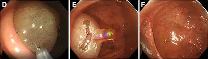 Image result for Adult Intussusception