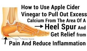 Home Remedies For Heel Spurs Home Remedies Arthritis Remedies Remedies