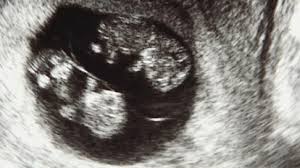 Dette kan føre til lavt blodtrykk som gjør deg ør i hodet. Kan Det Vaere To Gravid Babyverden No