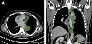The most common staging system used when describing mesothelioma is the tumor node metastasis (tnm) system. Volumetry Of Malignant Pleural Mesothelioma A B The Marked Tumor Download Scientific Diagram