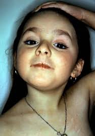 The Ichthyoses: The common thread in a life of investigation or Making a  professional life from the study and treatment of d