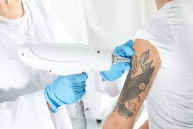Laser tattoo removal helps speed up the natural fading process of tattoos by using light energy to break down the large ink particles. How Does Laser Tattoo Removal Work Satin Med Spa