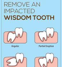 An Impacted Wisdom Tooth Takes Place When Your Wisdom Teeth Grow At An Awkward Angle Or If There Is Not Enough Room F Wisdom Teeth Impacted Wisdom Teeth Teeth