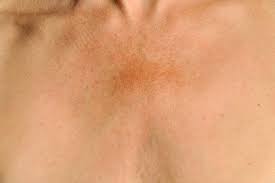 Image result for Melasma