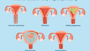 1:49 momism mommas 152 361. Does Early Pregnancy Bleeding Mean A Miscarriage