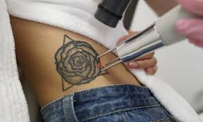 Currently offered at our tucson az location, this laser offers two wavelengths to treat many colors of ink in any skin tone. Laseraway From 115 Tucson Ak Groupon