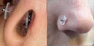 Piercing Bumps The Complete Infection And Treatment Guide 2020