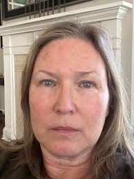 Breast Implant Illness and Removal Struggles