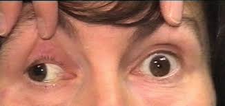 Image result for Pupillary Paralysis