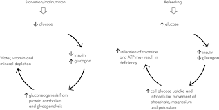 Image result for Refeeding Syndrome