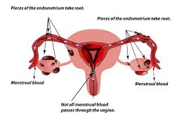 In women, monthly hormonal changes cause the lining of the womb (called the endometrial tissue) to. Endometriosis Assessment Women S Ultrasound Specialists Melbourne