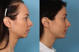 How much does the surgery cost? Dr Sidle Hairline Lowering Hairline Lowering