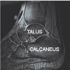 There is also some contact with the if a person brings their foot into a dorsiflexed position and they then roll the ankle outwards, then the lateral process of the talus gets compressed. The Talus Bone Of The Foot In A Mr Image Download Scientific Diagram