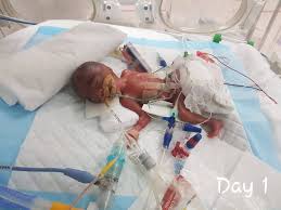 Birth weight plays an important role, too. Singapore S Smallest Premature Baby Weighing 345g Beats The Odds To Survive Parents Indebted To Medical Team Cna