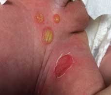 Baby heat rash meningitis rash strep rash chicken pox baby drool rash baby eczema rash hives baby allergy rash baby fungal rash cradle cap. 2 Month Old Male With Unusual Blistering Rash In The Diaper Area