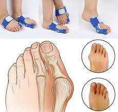 Bunions are when a bump forms at the base of the big toe. Bunion Splint Find The Best Style For You Foot Pain Explored