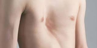 If the child's bones are still growing, a brace can help flatten the chest. Surgical Correction Of Pectus Excavatum And Carinatum Deformities My Health Turkey