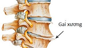 Résultat de recherche d'images pour "hình ảnh gai đôi cột sống"