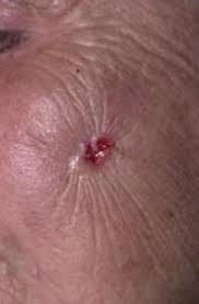 * adenocarcinoma is a malignant tumor originating in the epithelial cells of glandular tissue and forming glandular structures. Basal Cell Carcinoma Lloyd Dermatology Center