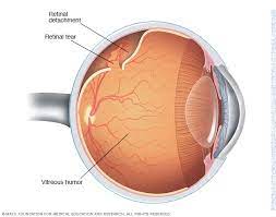 It's often accompanied by the sudden onset of symptoms such as floaters and flashing lights. Retinal Detachment Symptoms And Causes Mayo Clinic