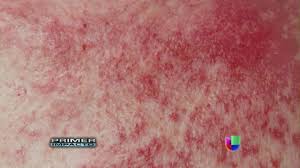 Esta página de desambiguación enumera artículos que tienen títulos similares. Campana De Vacunacion Contra La Culebrilla O Herpes Zoster Primer Impacto Youtube