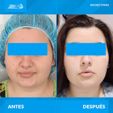Resultados excelentes gracias a la mejor técnica no quirúrgica y  mínimamente invasiva en Bichectomía con el Instructor, Dr. David Flor. Ven  y capacítate con los mejores profesionales. Somos GRUCAP el Grupo de