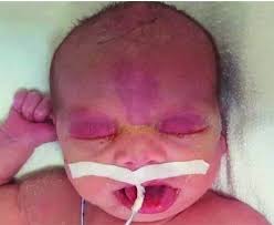 Image result for Nevus Simplex