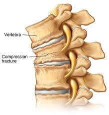 Image result for Vertebral Compression Fracture