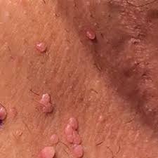 Hi i had radical surgery 17 days ago for squamous cell cancer in my groin. Can You Identify These Numerous Papules In The Groin Area Mdedge Obgyn