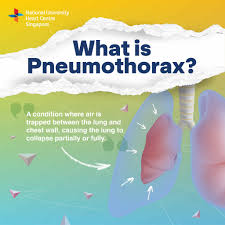 Image result for Pneumothorax
