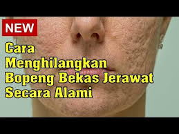 Ketika anda berolahraga, stres akan terlepas. Video Cara Alami Menghilangkan Lubang Bekas Komedo Hari Ini