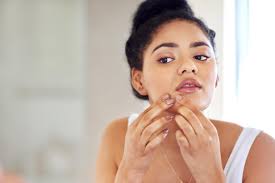 Foods to avoid during an acne breakout, according to dermatologists