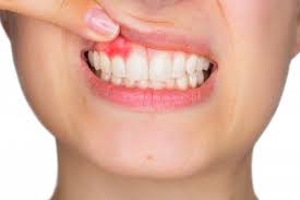 Image result for gum cancer symptoms