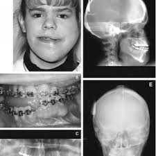 PDF) Craniofacial and Dental Manifestations of Proteus Syndrome: A Case  Report