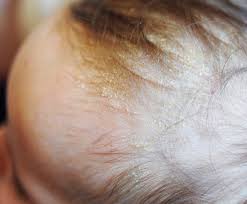 Image result for sores on the head in children