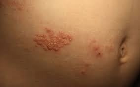 En pocos días, una erupción en la piel aparece en. Gurtelrose Herpes Zoster Erste Anzeichen Typische Symptome Behandlung Dauer Onmeda De