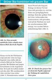 Glaukom Gruner Star Kombiniert Mit Grauem Star Patienten Ratgeber Gruner Star Kombiniert Mit Grauem Star Ausgabe 8 Pdf Free Download