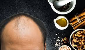 So rather than using cinnamon oil directly, which you can if you want, use a shampoo that contains this type of oil. Hair Loss Treatment Try Cinnamon Essential Oil Express Co Uk