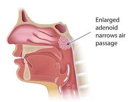 صورة Adenoidectomy surgery