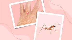 Image result for ant bite