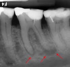 Image result for Periodontal Abscess