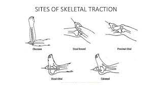 What is skeletal traction skin traction bucks traction and. Skeletal Traction Pin Insertion Sites Epomedicine
