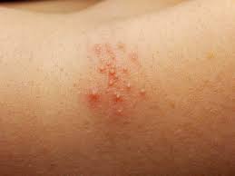 Treating Heat Rashes In The Groin Carpe