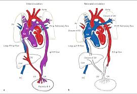 Image result for Delayed Transition from Fetal Circulation