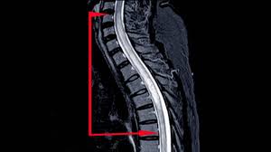 Magnetic resonance imaging (mri) or computerized tomography (ct) scan. Transverse Myelitis Causes Symptoms Diagnosis Treatment Medicine Com