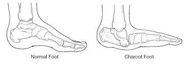 Charcot foot is a condition causing weakening of the bones in the foot that can occur in people who have significant nerve damage (neuropathy). Charcot Neuroarthropathy Infinity Foot Ankle Dr Parul K Patel Dpm