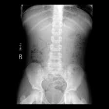 Image result for Pediatric Constipation
