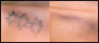 Maybe you would like to learn more about one of these? Laser Tattoo Removal Gentle Touch Medispa